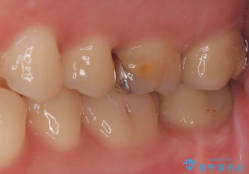 神経を抜かずに守る。MTAを用いた部分的断髄法と精密セラミック修復の治療前