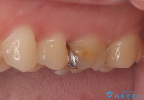 神経を抜かずに守る。MTAを用いた部分的断髄法と精密セラミック修復の治療前