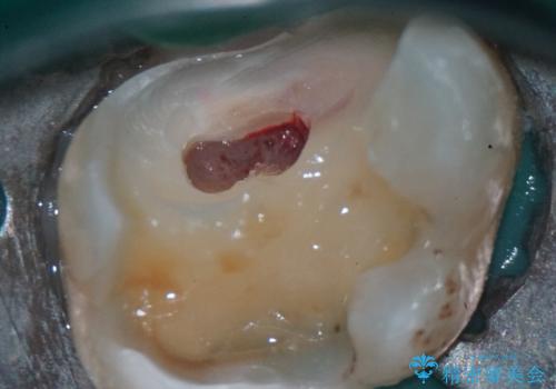 神経を抜かずに守る。MTAを用いた部分的断髄法と精密セラミック修復の治療後