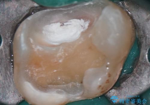 神経を抜かずに守る。MTAを用いた部分的断髄法と精密セラミック修復の治療後