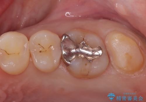 神経を抜かずに守る。MTAを用いた部分的断髄法と精密セラミック修復の治療中