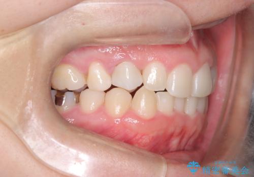 前歯のガタつきと逆の噛み合わせを、短期間のインビザラインで改善の治療後