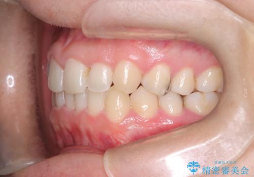 前歯のガタつきと逆の噛み合わせを、短期間のインビザラインで改善の治療後