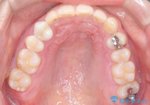 前歯のガタつきと逆の噛み合わせを、短期間のインビザラインで改善の治療後