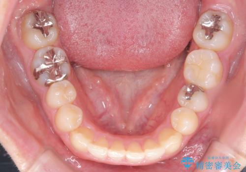 前歯のガタつきと逆の噛み合わせを、短期間のインビザラインで改善の治療後