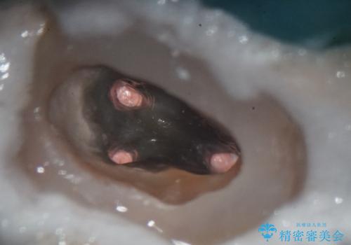 全ての銀歯をセラミックへ。お口全体をメタルフリーにして笑顔まで明るくの治療中