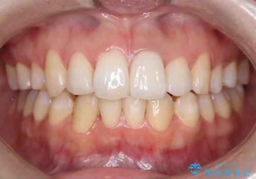 前歯の気になる変色を解消。再根管治療とオールセラミックで自然な美しさへの治療後