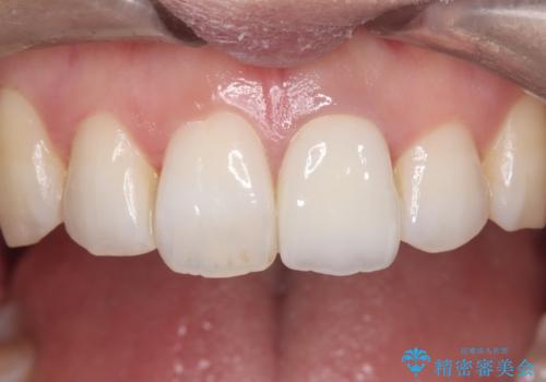 前歯の気になる変色を解消。再根管治療とオールセラミックで自然な美しさへの症例 治療後