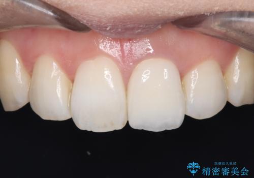 前歯の気になる変色を解消。再根管治療とオールセラミックで自然な美しさへの治療後