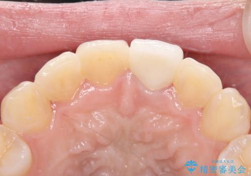 前歯の気になる変色を解消。再根管治療とオールセラミックで自然な美しさへの治療後