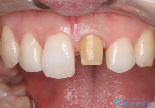 前歯の気になる変色を解消。再根管治療とオールセラミックで自然な美しさへの治療中