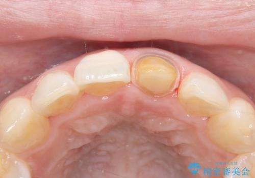 前歯の気になる変色を解消。再根管治療とオールセラミックで自然な美しさへの治療中