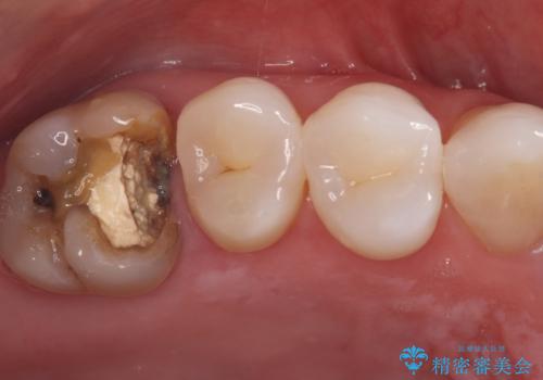 詰め物が外れた奥歯。MB2の発見の治療前