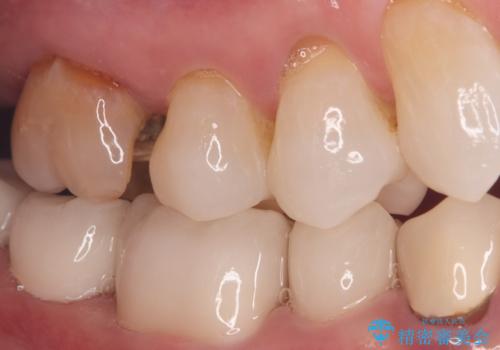 詰め物が外れた奥歯。MB2の発見の治療前