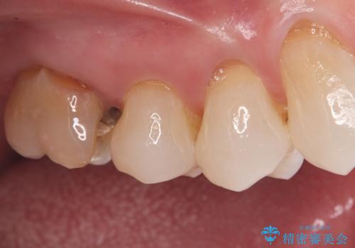 詰め物が外れた奥歯。MB2の発見の治療前