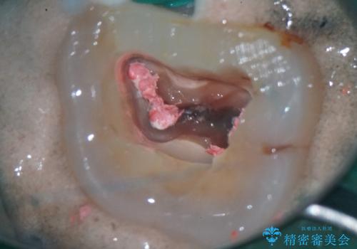 詰め物が外れた奥歯。MB2の発見の治療前