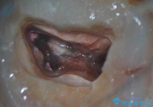 詰め物が外れた奥歯。MB2の発見の治療中