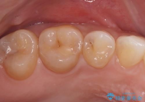 見逃しやすい小さな穴も精密に修復。自然な見た目のセラミックインレー