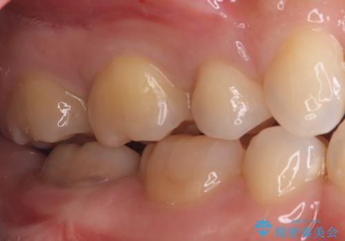 見逃しやすい小さな穴も精密に修復。自然な見た目のセラミックインレーの治療前