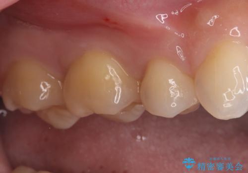 見逃しやすい小さな穴も精密に修復。自然な見た目のセラミックインレーの治療前