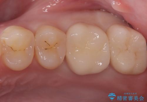 神経を抜かずに守る。MTAを用いた部分的断髄法と精密セラミック修復の症例 治療後