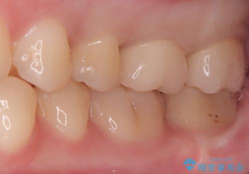 神経を抜かずに守る。MTAを用いた部分的断髄法と精密セラミック修復の治療後