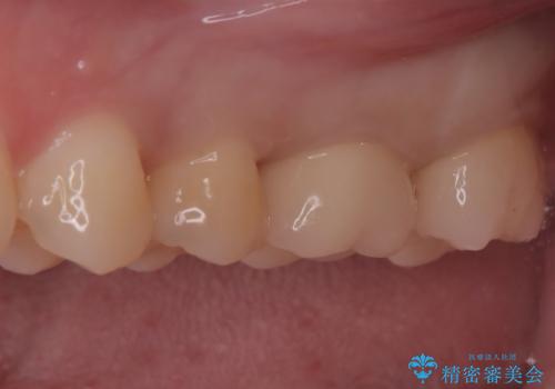 神経を抜かずに守る。MTAを用いた部分的断髄法と精密セラミック修復の治療後