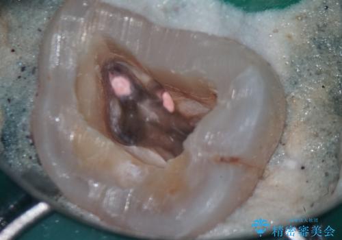 詰め物が外れた奥歯。MB2の発見の治療後