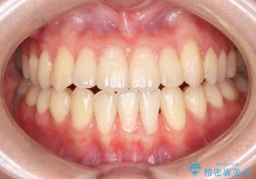 閉院による転院からのリカバリー。インビザラインからワイヤー矯正への切り替えの症例 治療後