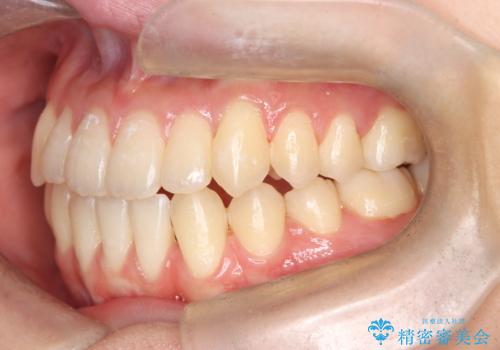 閉院による転院からのリカバリー。インビザラインからワイヤー矯正への切り替えの治療後