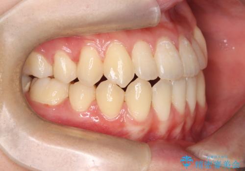 閉院による転院からのリカバリー。インビザラインからワイヤー矯正への切り替えの治療後