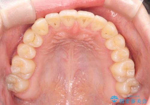 閉院による転院からのリカバリー。インビザラインからワイヤー矯正への切り替えの治療後