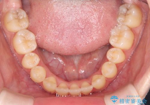 閉院による転院からのリカバリー。インビザラインからワイヤー矯正への切り替えの治療後