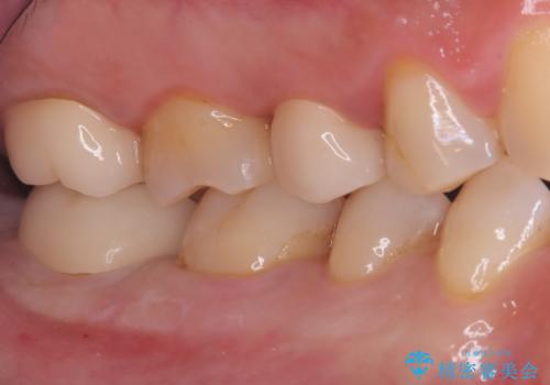 全ての銀歯をセラミックへ。お口全体をメタルフリーにして笑顔まで明るくの治療後