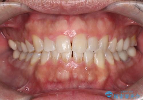 全ての銀歯をセラミックへ。お口全体をメタルフリーにして笑顔まで明るくの症例 治療後