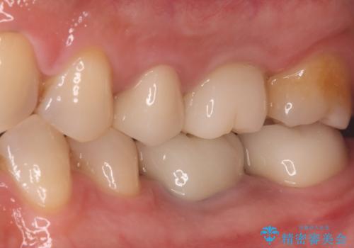 全ての銀歯をセラミックへ。お口全体をメタルフリーにして笑顔まで明るくの治療後