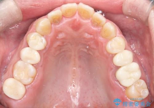 全ての銀歯をセラミックへ。お口全体をメタルフリーにして笑顔まで明るくの治療後