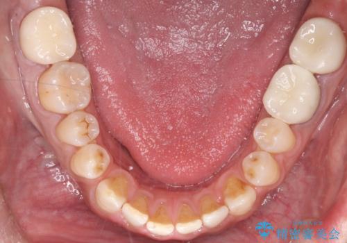 全ての銀歯をセラミックへ。お口全体をメタルフリーにして笑顔まで明るくの治療後