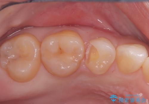 見逃しやすい小さな穴も精密に修復。自然な見た目のセラミックインレーの治療中
