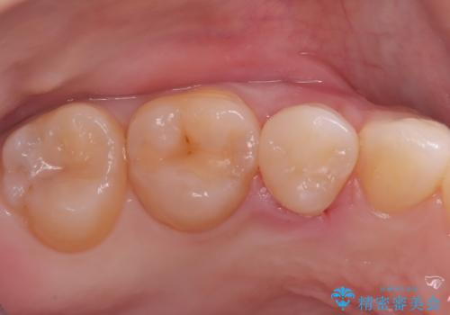見逃しやすい小さな穴も精密に修復。自然な見た目のセラミックインレーの治療後