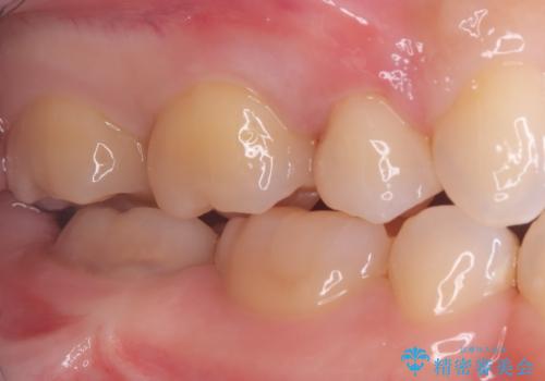 見逃しやすい小さな穴も精密に修復。自然な見た目のセラミックインレーの治療後