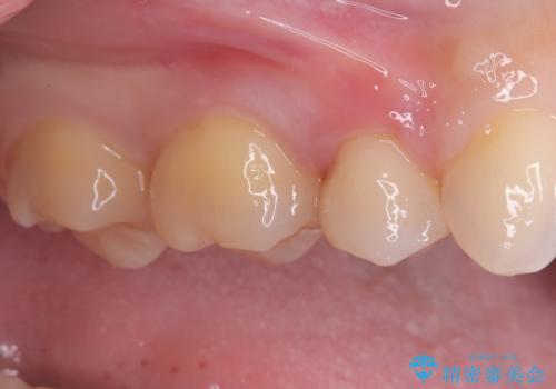 見逃しやすい小さな穴も精密に修復。自然な見た目のセラミックインレーの治療後
