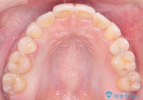 重度のガタガタを効率よく改善。ワイヤー矯正とインビザラインの併用治療の治療後
