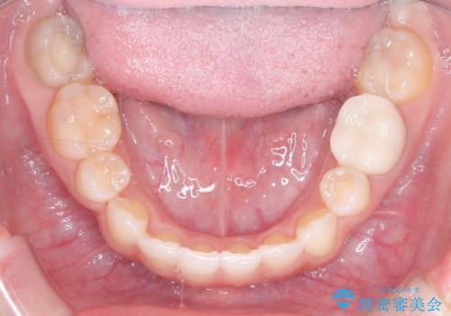 重度のガタガタを効率よく改善。ワイヤー矯正とインビザラインの併用治療の治療後