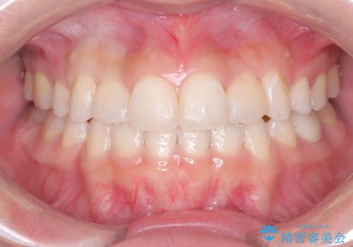 重度のガタガタを効率よく改善。ワイヤー矯正とインビザラインの併用治療の症例 治療後