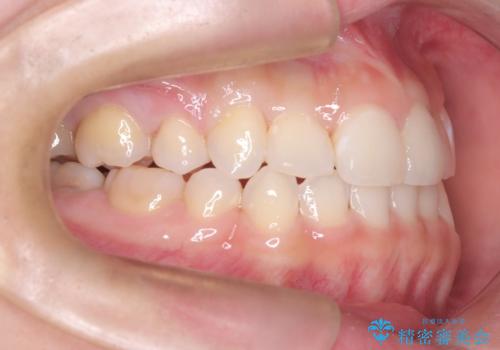 重度のガタガタを効率よく改善。ワイヤー矯正とインビザラインの併用治療の治療後