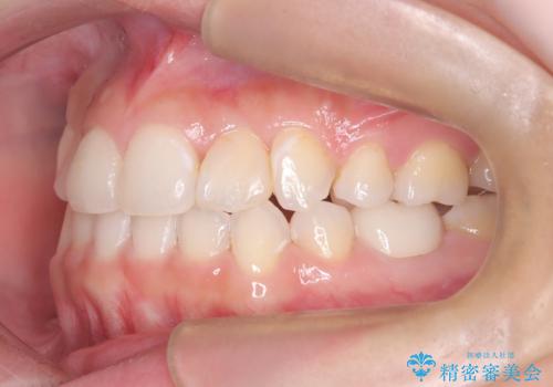 重度のガタガタを効率よく改善。ワイヤー矯正とインビザラインの併用治療の治療後