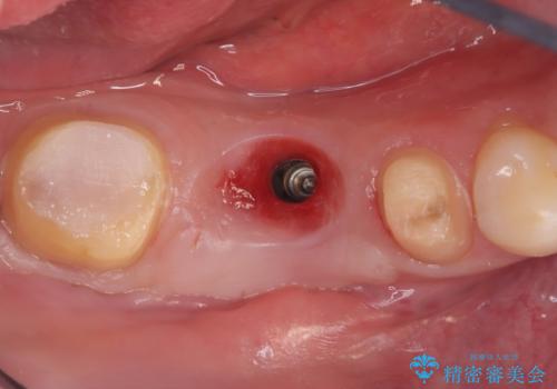 ブリッジからインプラントへの移行と歯周形成外科の治療中
