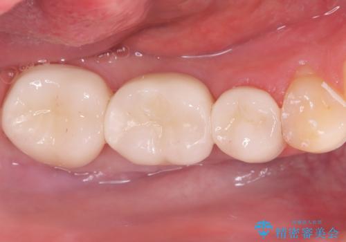 ブリッジからインプラントへの移行と歯周形成外科の治療後