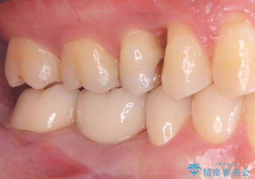 ブリッジからインプラントへの移行と歯周形成外科の治療後
